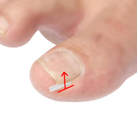 Toenail Relief Strips set