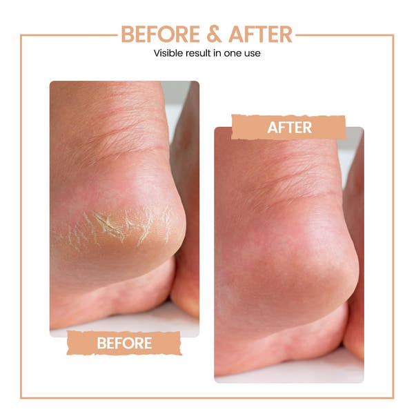 EliteCare Rechargeable Callus Remover