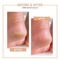 EliteCare Rechargeable Callus Remover