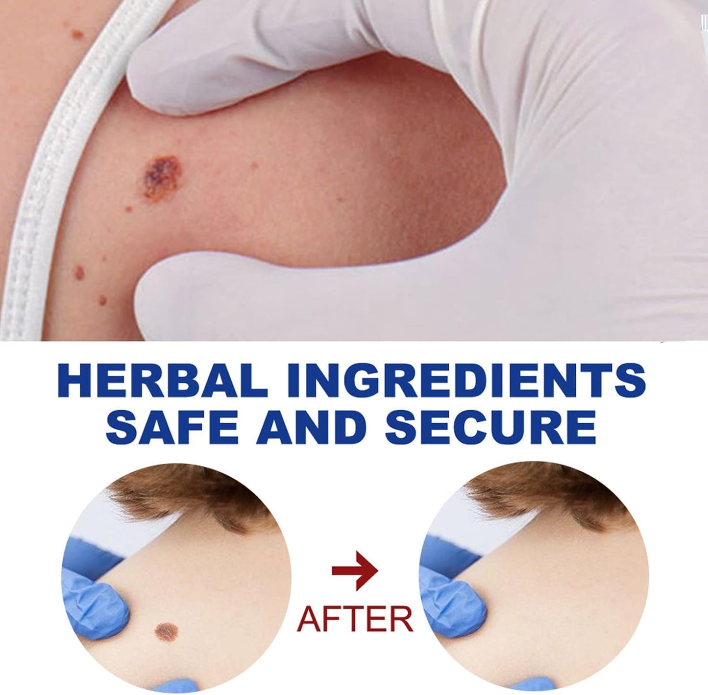 Herbal Wart Remover Cream