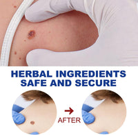 Herbal Wart Remover Cream