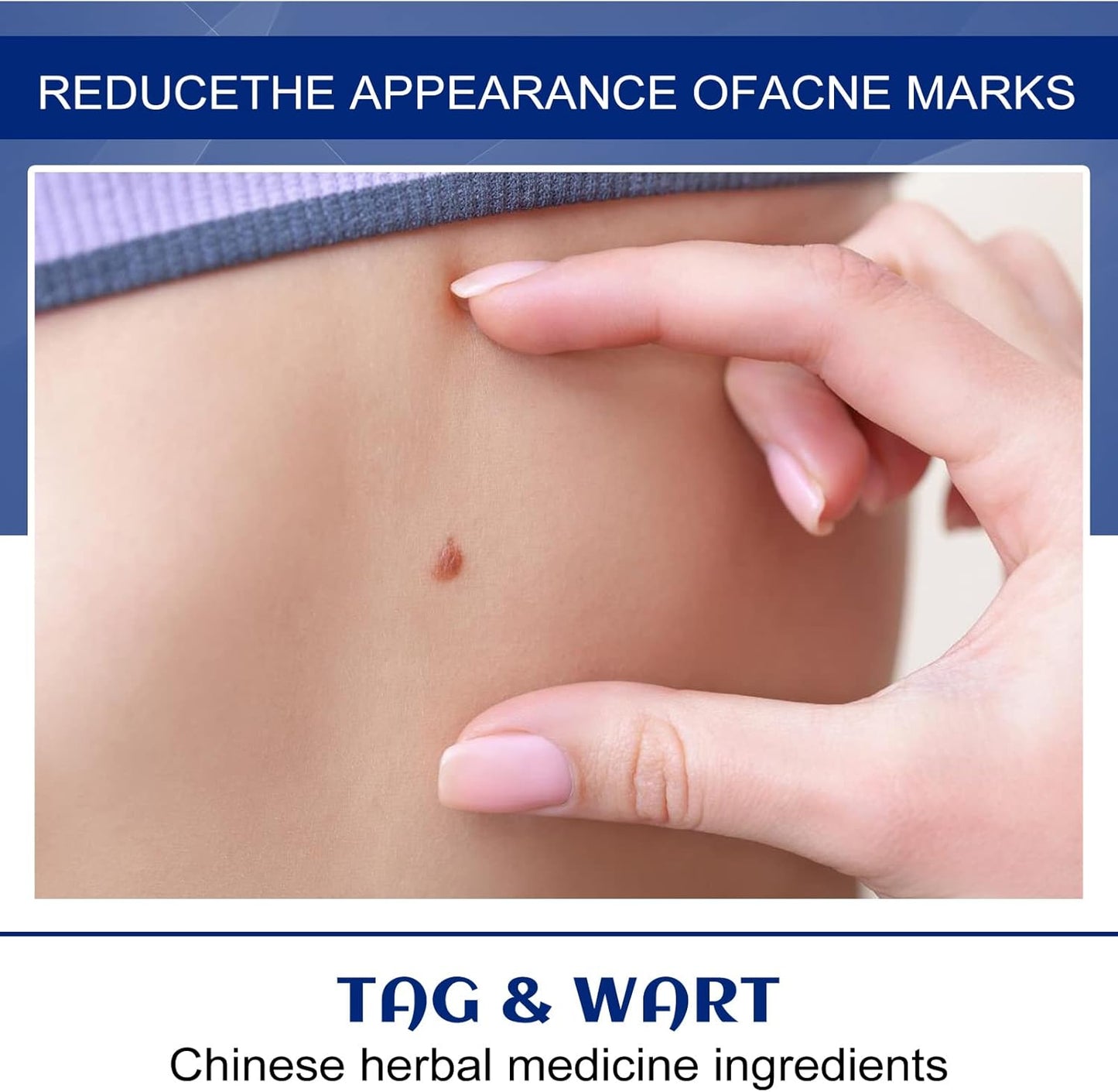 Herbal Wart Remover Cream