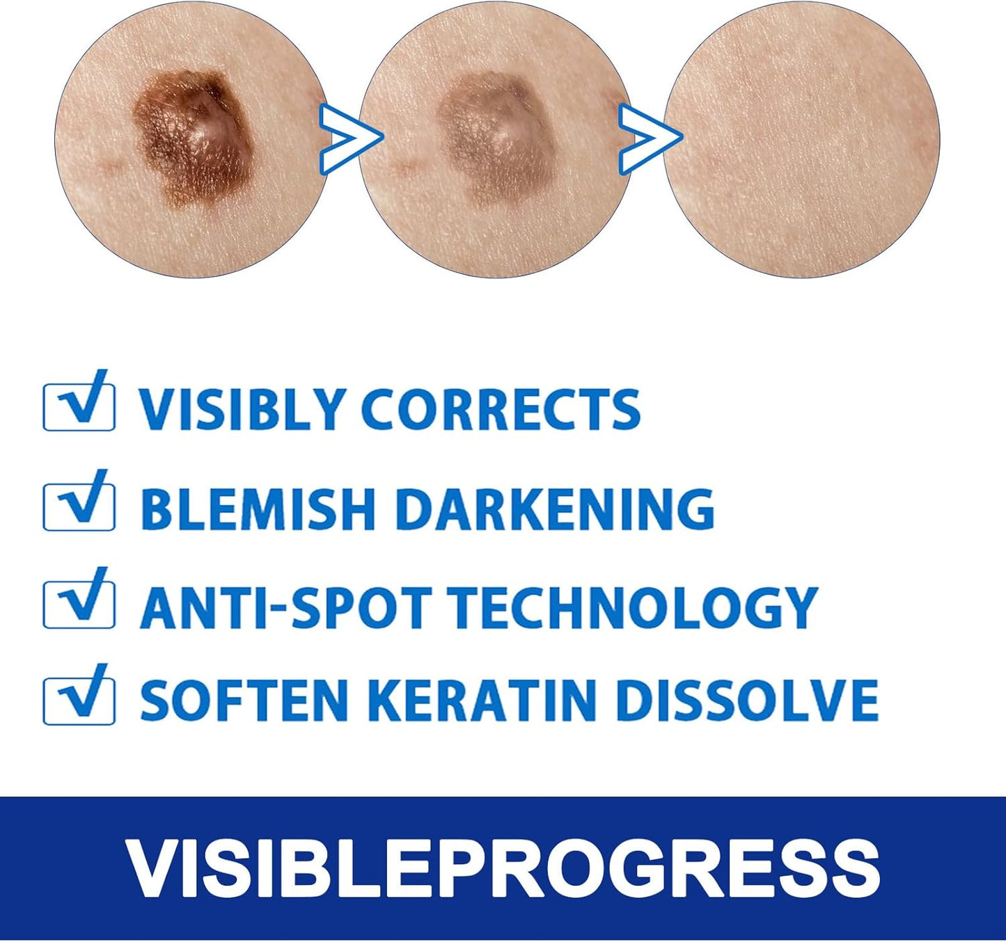 Herbal Wart Remover Cream