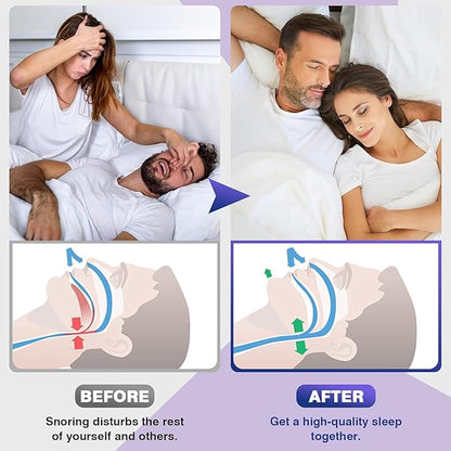 ANTI SNORING DEVICES