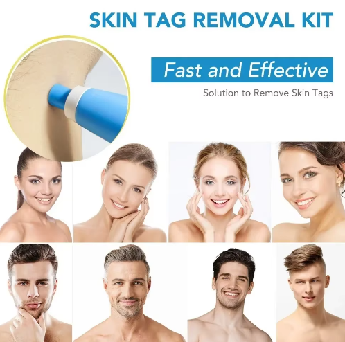 Painless Skin Tag, Mole, and Wart Removal Kit