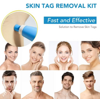Painless Skin Tag, Mole, and Wart Removal Kit