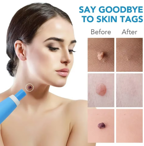 Painless Skin Tag, Mole, and Wart Removal Kit