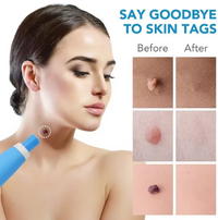 Painless Skin Tag, Mole, and Wart Removal Kit
