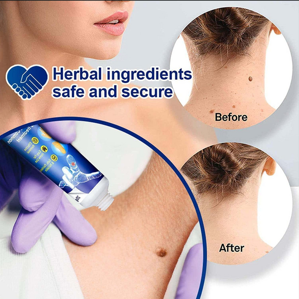 Wart Remover Cream