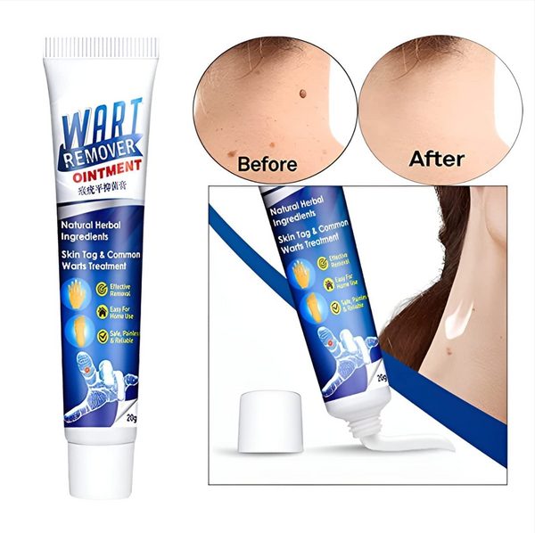 Wart Remover Cream