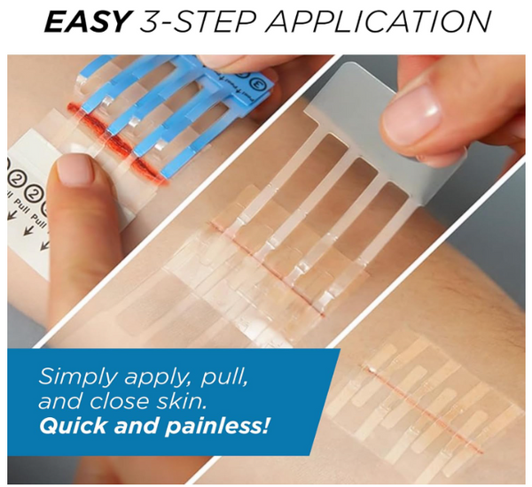 Emergency Laceration Closures