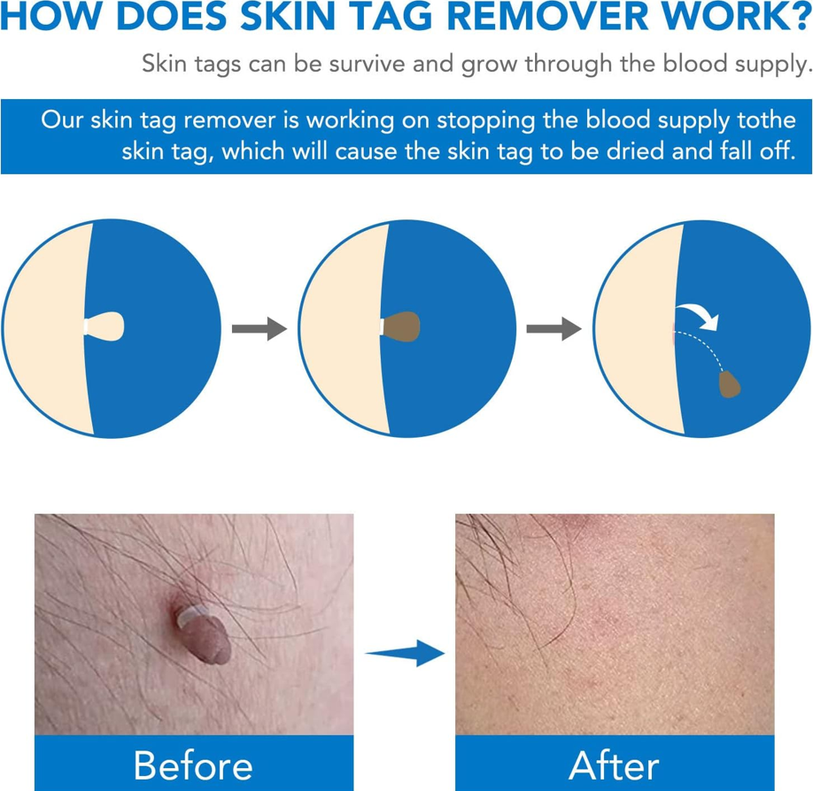 Skin Tag Removal Tool Kit