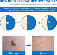Skin Tag Removal Tool Kit