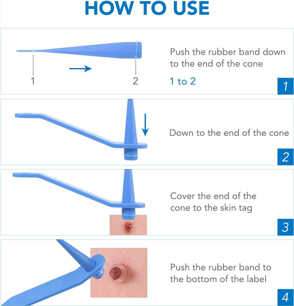 Skin Tag Removal Tool Kit