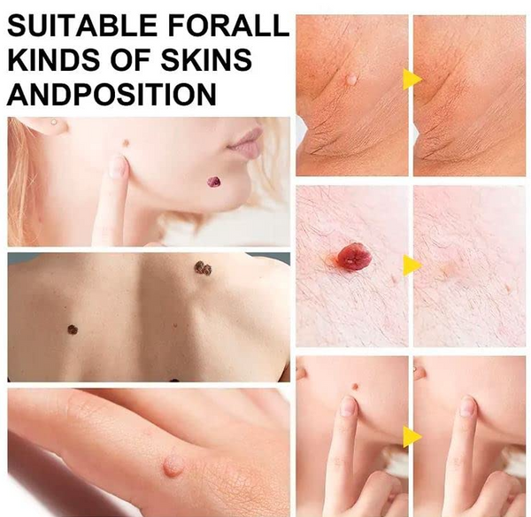 Skin Tag Removal Tool Kit