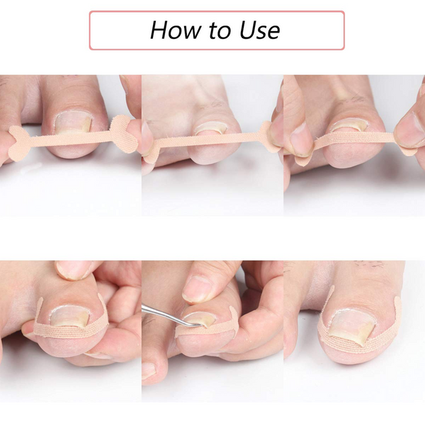 Toenail Correction Strips
