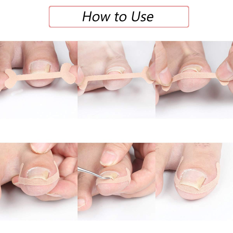 Toenail Correction Strips